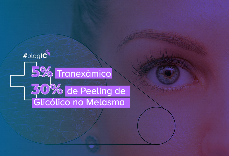 5% Tranexâmico + 30% de Peeling de Glicólico no Melasma