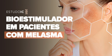 Bioestimulador em pacientes com melasma