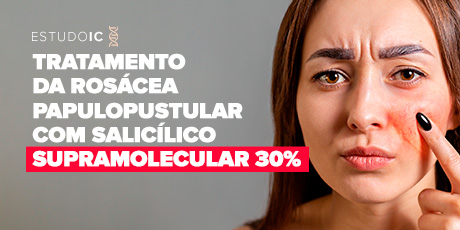 Tratamento da rosácea papulopustular com salicílico supramolecular 30%
