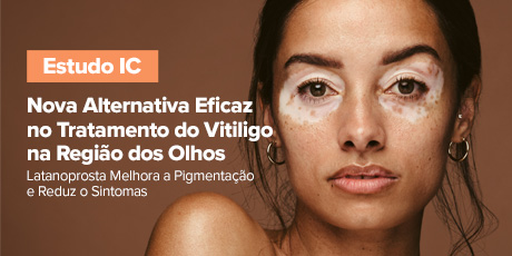 Nova Alternativa Eficaz no Tratamento do Vitiligo na Região dos Olhos